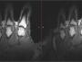 Mystery solved: Why do knuckles crack?