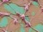 'Twin' tumour found in woman's head
