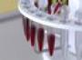 Ovarian cancer blood test 'boost'