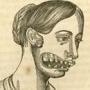 6 Nightmare Historical Diseases Humanity Forgot Are Possible